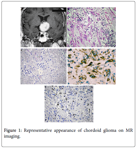 clinical-pathology-chordoid-glioma