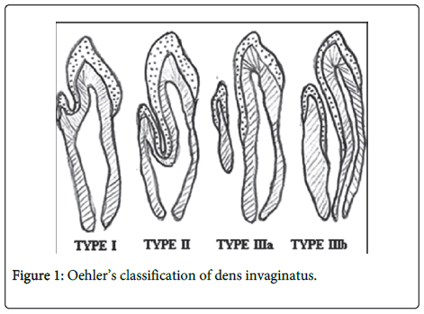 clinical-pathology-dens-invaginatus