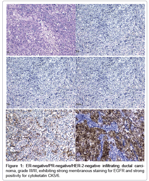 clinical-pathology-ductal-carcinoma