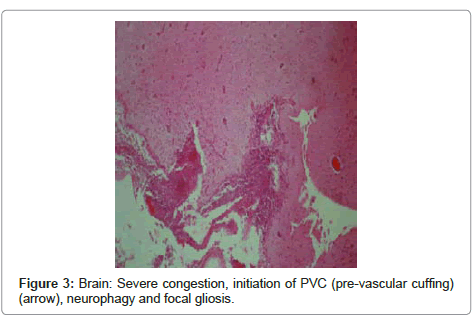 clinical-pathology-focal-gliosis