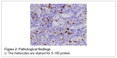 clinical-pathology-histiocytes-stained