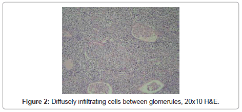clinical-pathology-infiltrating-cells