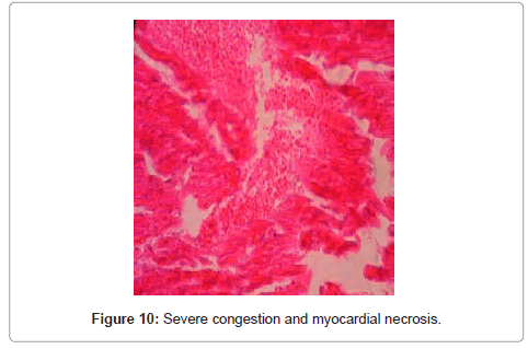 clinical-pathology-myocardial-necrosis