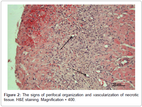 clinical-pathology-necrotic-perifocal