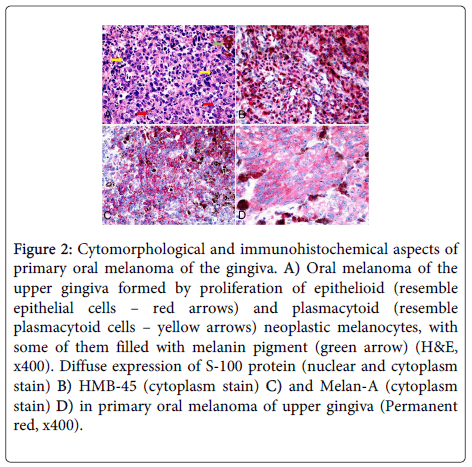 clinical-pathology-neoplastic-melanocytes