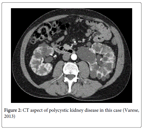 clinical-pathology-polycystic-kidney-disease