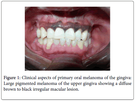 clinical-pathology-primary-oral-melanoma