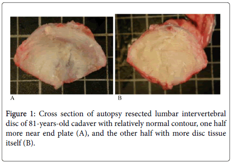 clinical-pathology-resected-lumbar-intervertebral