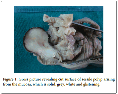 clinical-pathology-sessile-polyp-arising