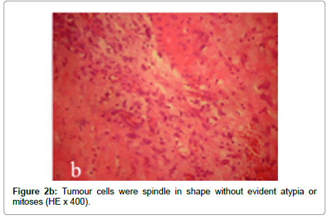 clinical-pathology-spindle-Tumour