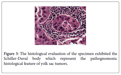 clinical-pathology-yolk-sac-tumors