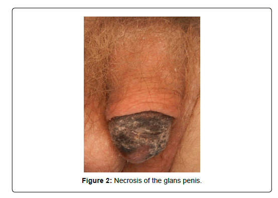 clinical-research-foot-Necrosis-glans-penis