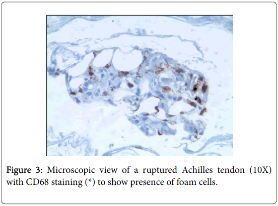 clinical-research-foot-ankle-Achilles-tendon