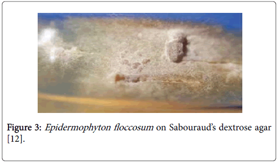 clinical-research-foot-ankle-Epidermophyton-floccosum