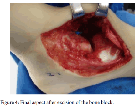 clinical-research-foot-ankle-Final-aspect-excision