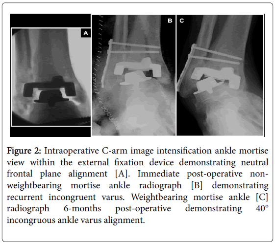 clinical-research-foot-ankle-Intraoperative-C-arm