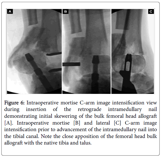 clinical-research-foot-ankle-Intraoperative-mortise