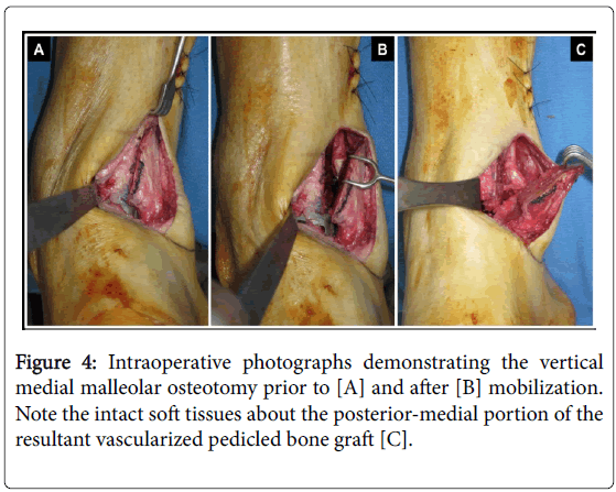 clinical-research-foot-ankle-Intraoperative-photographs