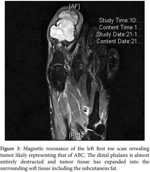 clinical-research-foot-ankle-Magnetic-resonance-first-toe