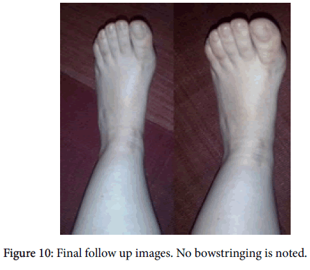 clinical-research-foot-ankle-No-bowstringing