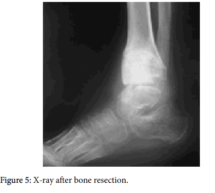 clinical-research-foot-ankle-X-ray-bone-resection