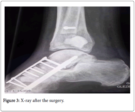 clinical-research-foot-ankle-after-surgery