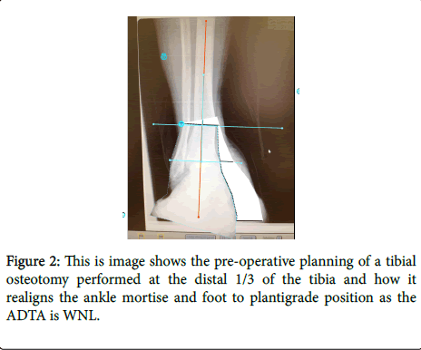 clinical-research-foot-ankle-ankle-mortise-foot-plantigrade