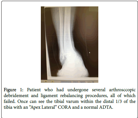 clinical-research-foot-ankle-debridement-ligament-rebalancing