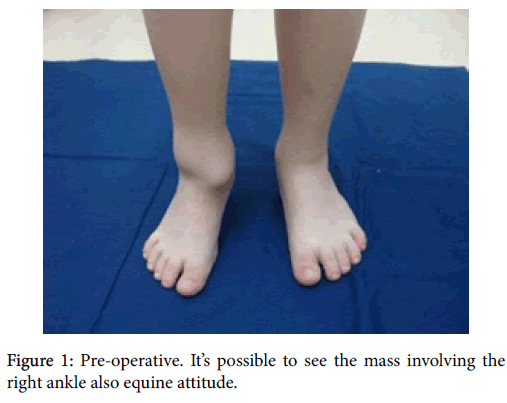 clinical-research-foot-ankle-right-ankle-equine-attitude