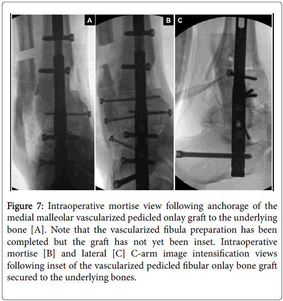 clinical-research-foot-ankle-vascularized-fibula-preparation