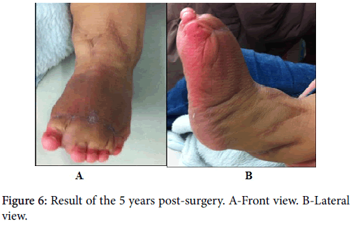 clinical-research-foot-ankle-years-post-surgery
