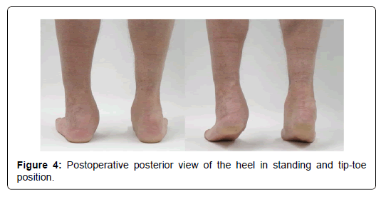 clinical-research-foot-heel-standing-tip-toe