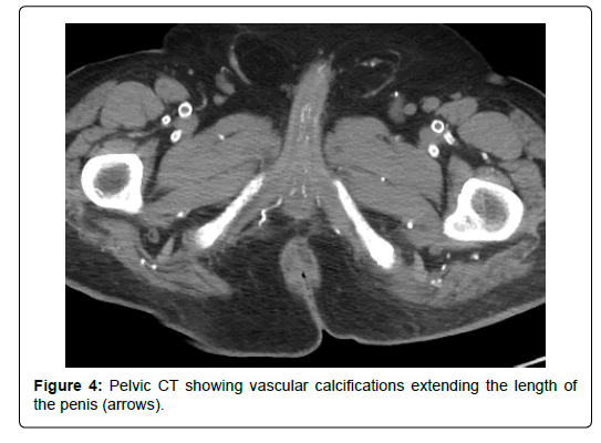 clinical-research-foot-vascular-calcifications