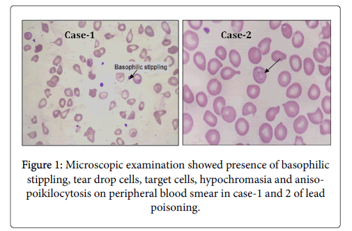 Target Cells Blood Film Causes Галерија слика