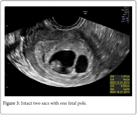 Twin dating scan