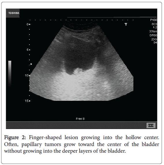 community-medicine-health-education-Finger-shaped-lesion
