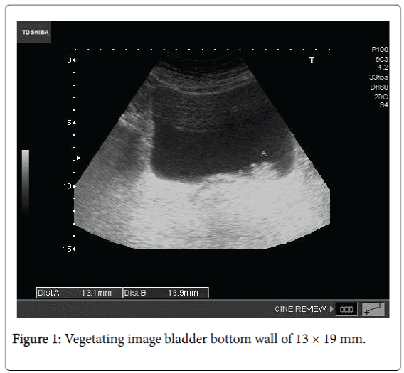 community-medicine-health-education-Vegetating-image-bladder