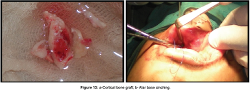 cosmetology-orofacial-surgery-Cortical-bone