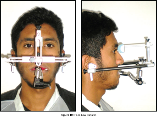 cosmetology-orofacial-surgery-Face-bow