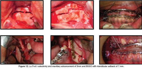 cosmetology-orofacial-surgery-Le-Fort