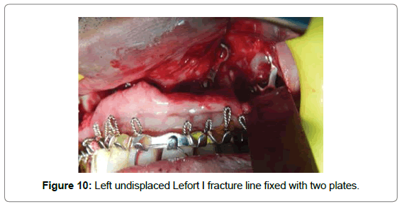cosmetology-orofacial-surgery-Left-undisplaced