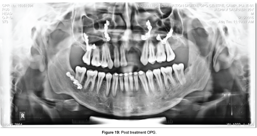 cosmetology-orofacial-surgery-Post-treatment-OPG