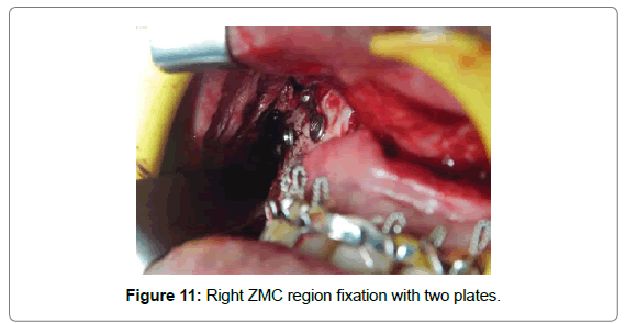 cosmetology-orofacial-surgery-Right-ZMC