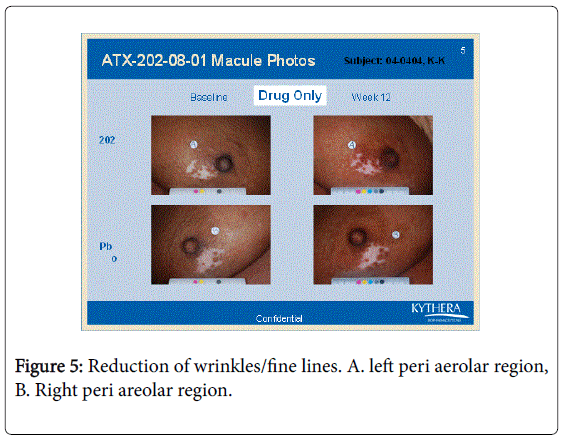 cosmetology-orofacial-surgery-Right-peri-areolar-region