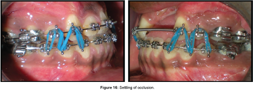 cosmetology-orofacial-surgery-Settling-occlusion