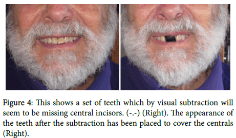 cosmetology-orofacial-surgery-central-incisors