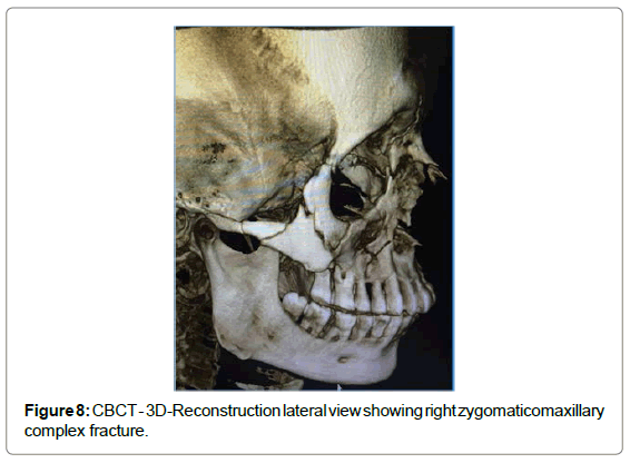 cosmetology-orofacial-surgery-complex-fracture