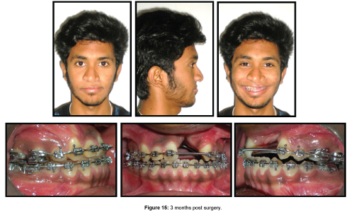 cosmetology-orofacial-surgery-months-post-surgery