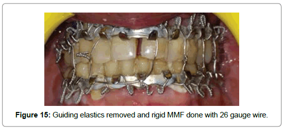 cosmetology-orofacial-surgery-rigid-MMF
