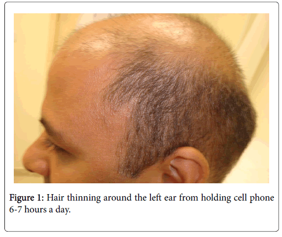 What Is Diffuse Hair Loss